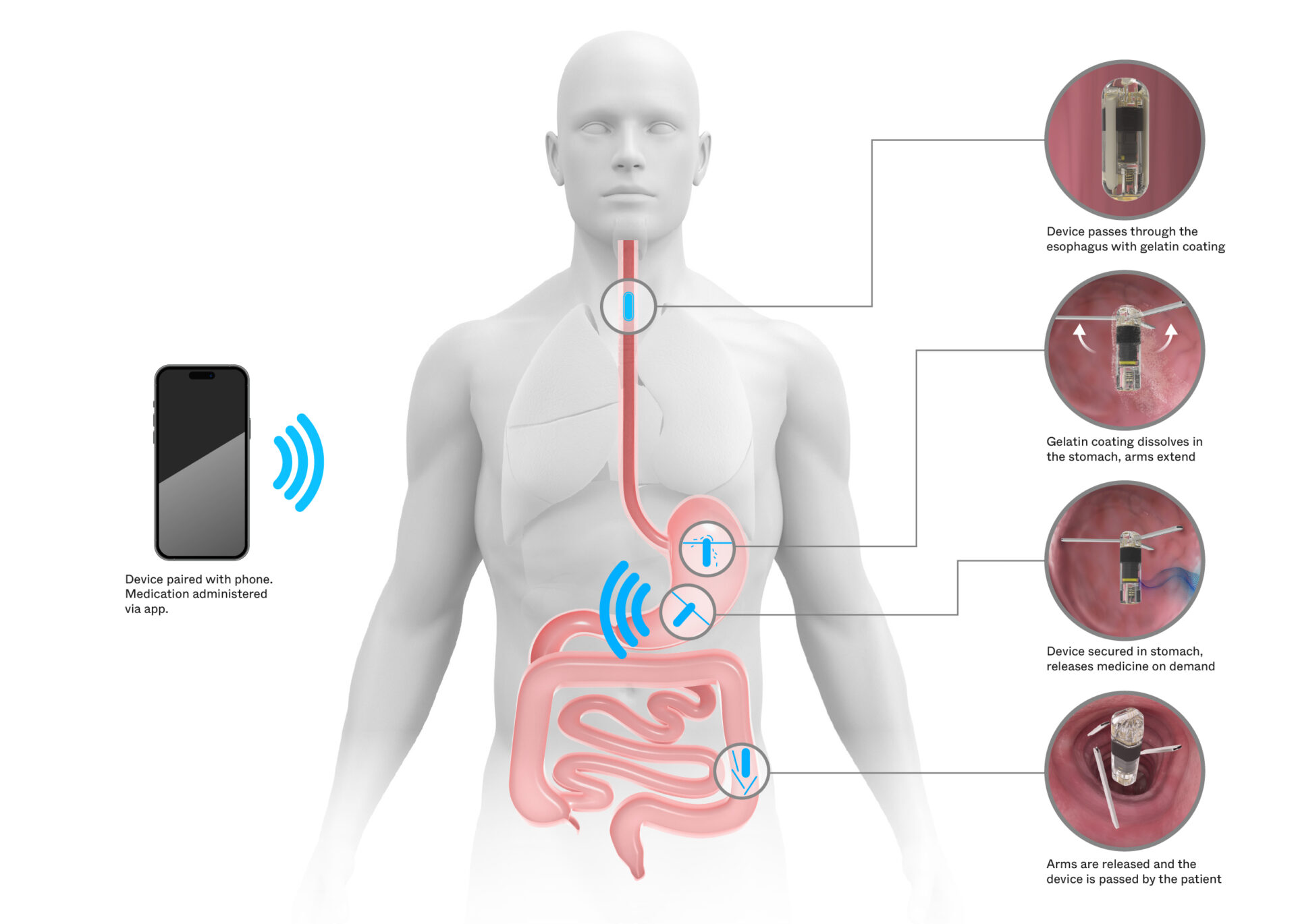 Diagram shows a swallowable medical device into the stomach, controlled by a phone to release medicine; inset images detail each step of the process inside the digestive tract.