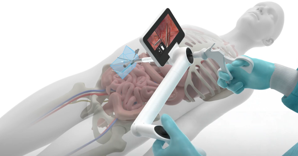 A medical professional uses a robotic-assisted device with a screen to perform minimally invasive surgery on a patient’s abdomen.